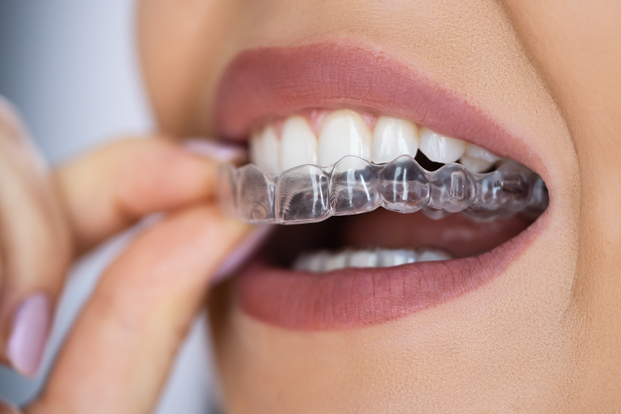Facts About Getting Inexpensive Invisalign