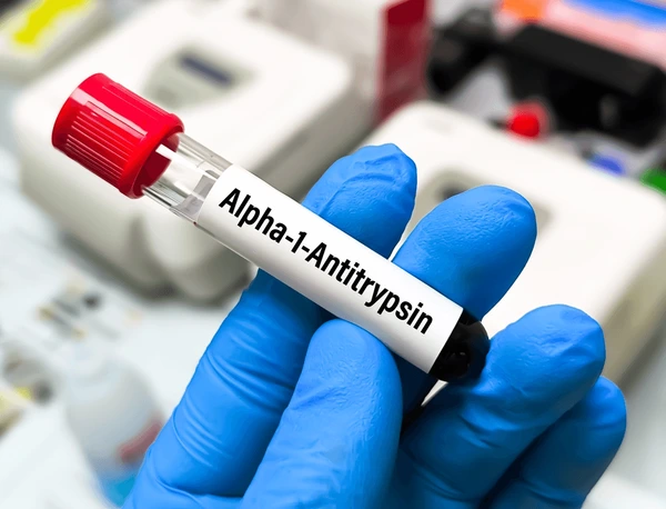 Understanding the Importance of Alpha-1 Antitrypsin Deficiency Screening