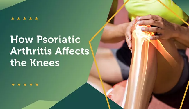 Psoriatic Arthritis Solutions: Effective Treatments and Lifestyle Strategies