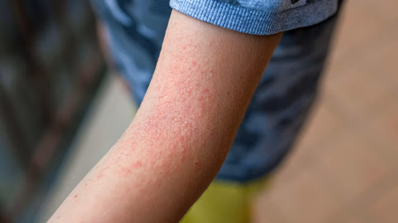 Finding Relief: A Guide to Atopic Dermatitis Medication