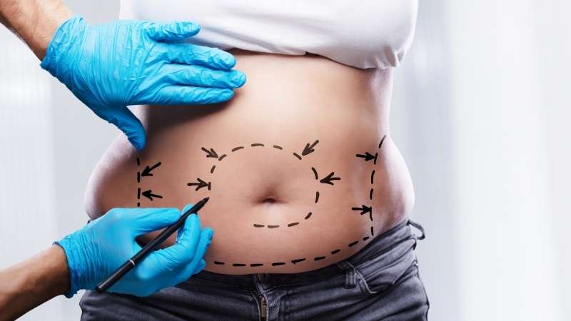 Sculpting Your Confidence: A Guide to Laser Belly Fat Removal