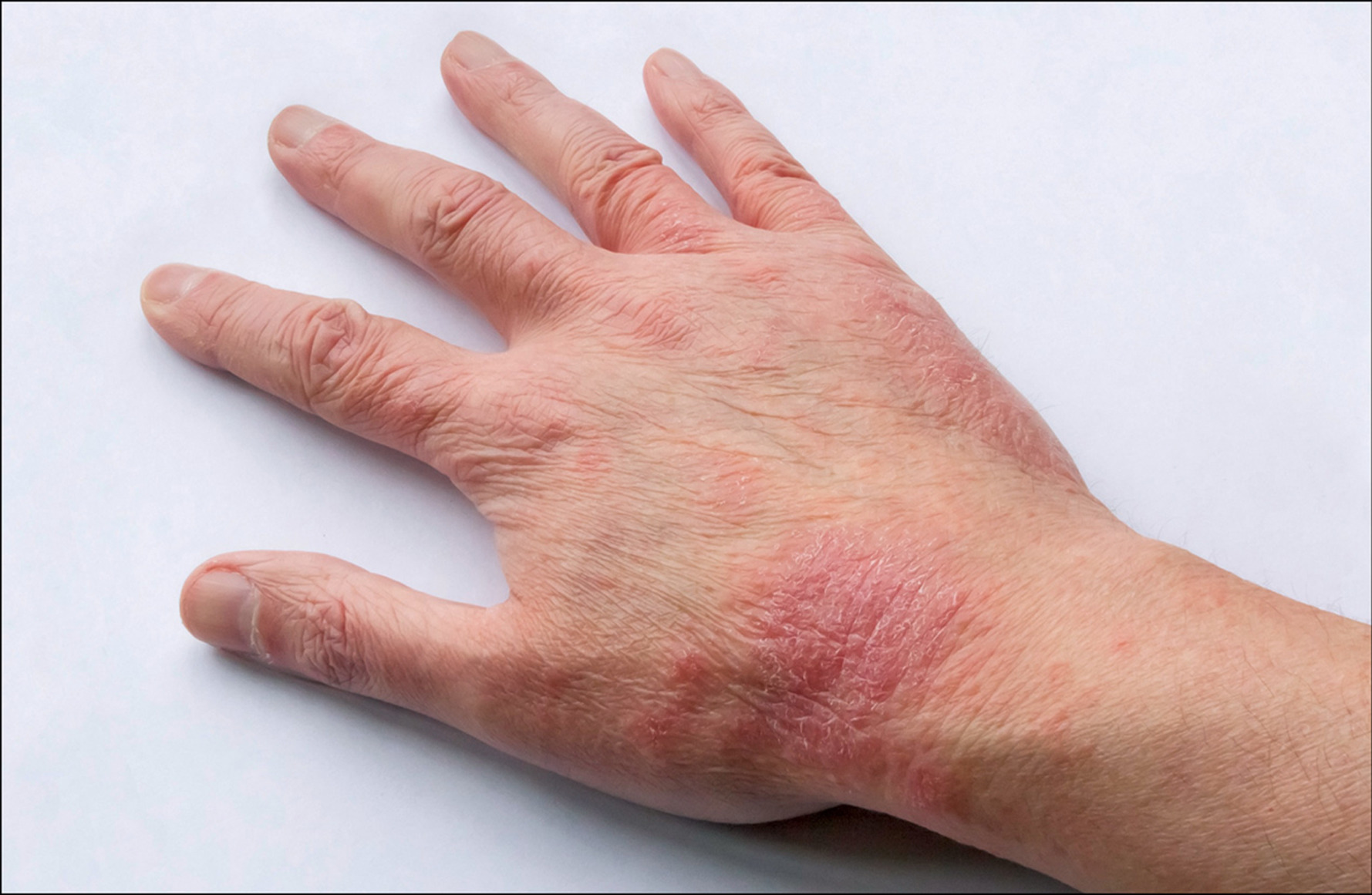 Is Your Skin Itchy and Red? It Might Be Dermatitis