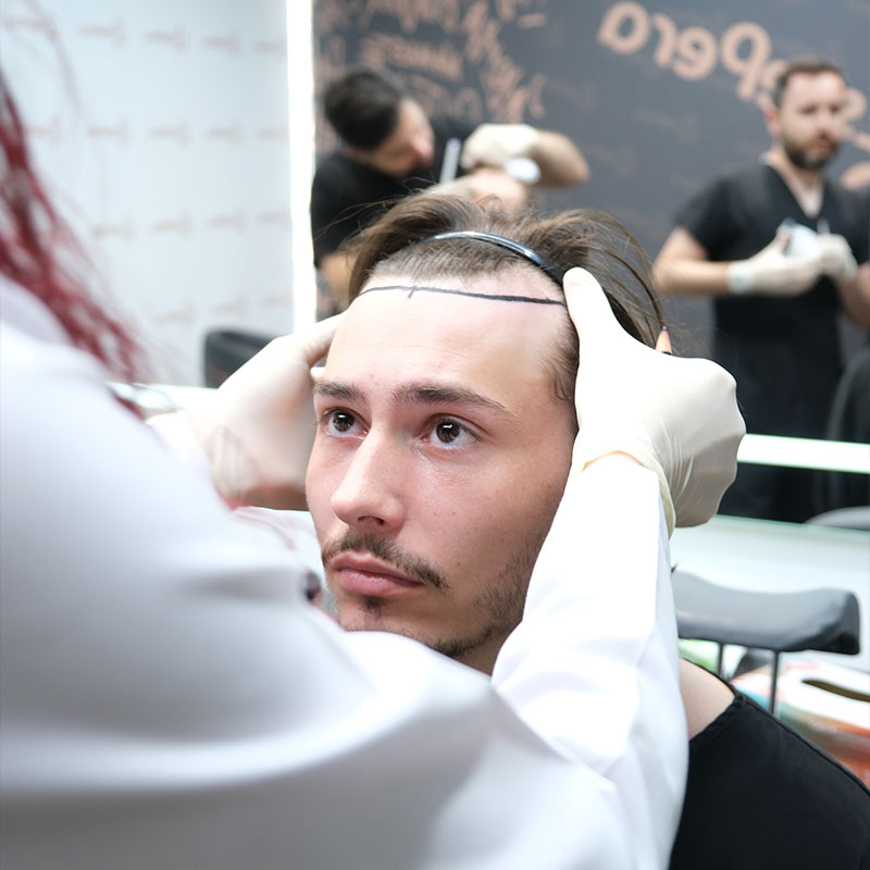 Is Hair Loss Affecting Your Confidence? What Will a Hair Transplant Cost?