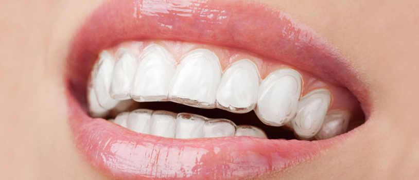 Invisible Teeth Aligners: Your Guide to a Straighter Smile