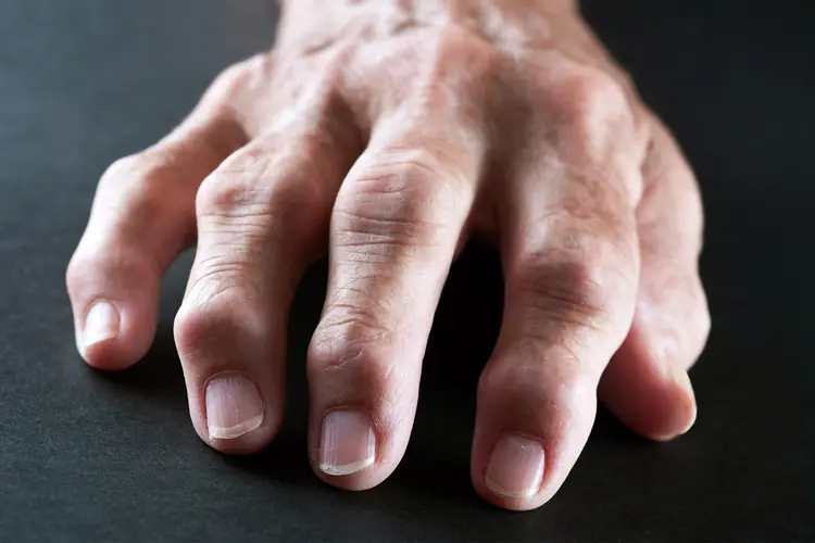 Understanding and Managing Rheumatoid Arthritis