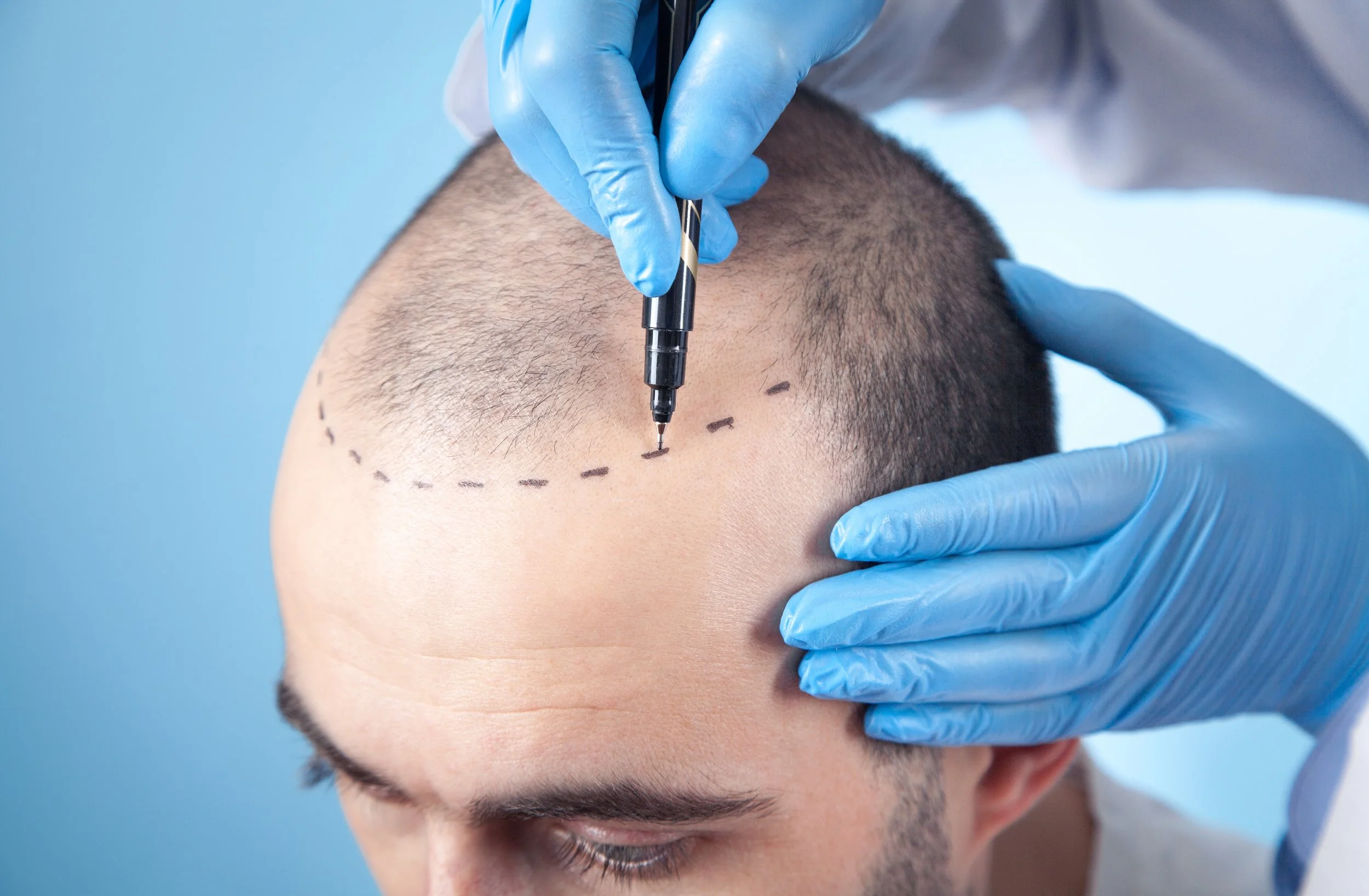 Understanding Hair Transplant Costs: A Clear Breakdown