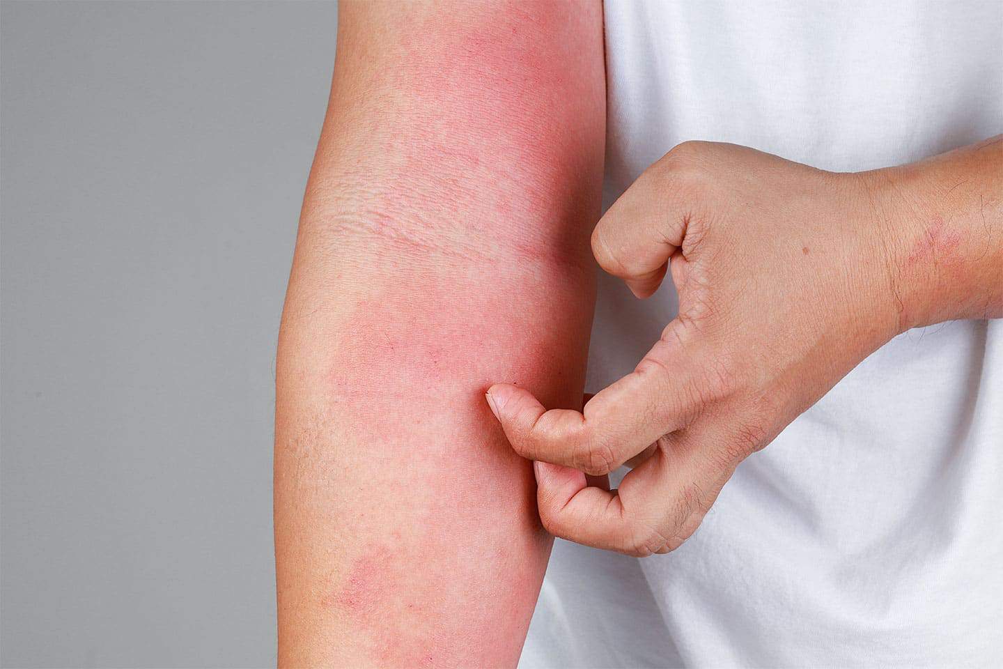 Finding Relief: Your Options for Atopic Dermatitis Treatment