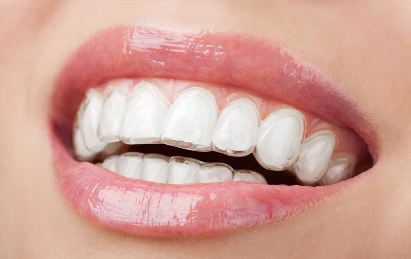 A Clear Path to a Straighter Smile: Understanding Invisible Braces