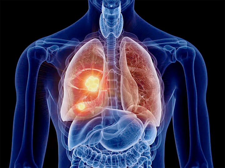 Navigating Your Lung Cancer Treatment Options
