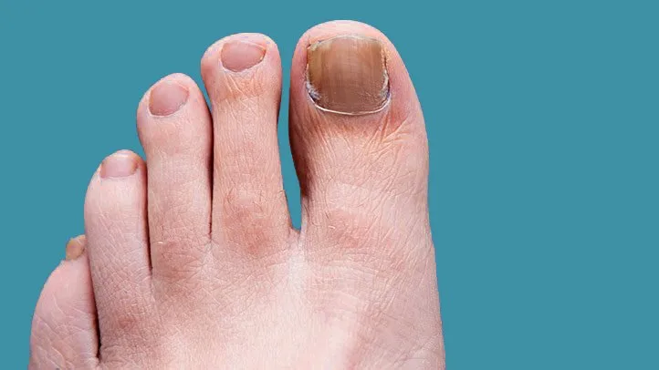 Finding a Cure: Your Options for Toenail Fungus Treatment